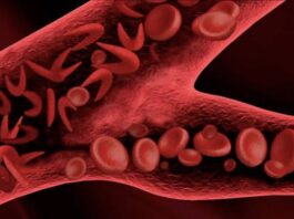 Drépanocytose au Niger : des solutions pour alléger le poids des soins aux familles