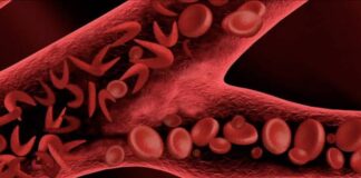 Drépanocytose au Niger : des solutions pour alléger le poids des soins aux familles
